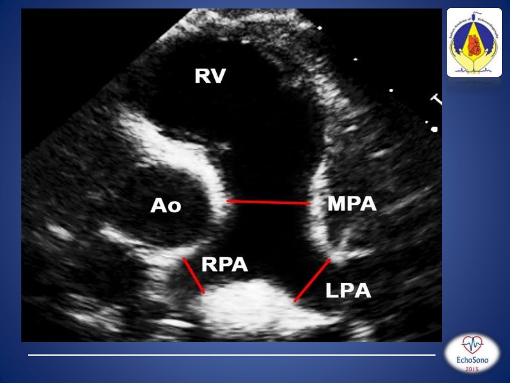 pediatric echo measurements technique z score