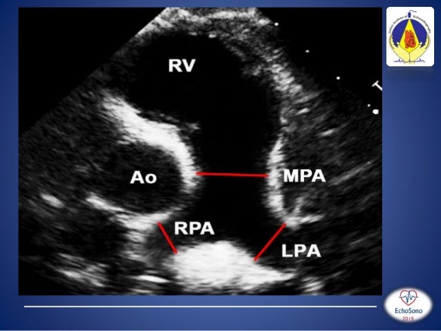 pediatric echo measurements technique z score