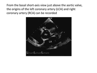 From the basal short-axis view just above the aortic valve,
the origins of the left coronary artery (LCA) and right
coronary artery (RCA) can be recorded
 