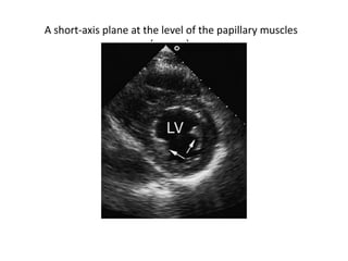 A short-axis plane at the level of the papillary muscles
(arrows).
 