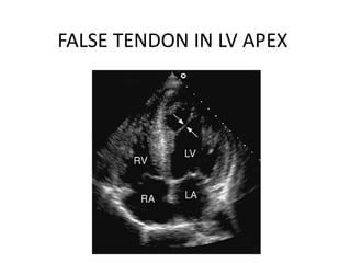 FALSE TENDON IN LV APEX
 
