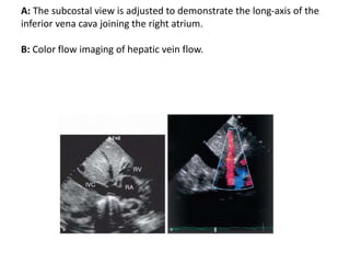 A: The subcostal view is adjusted to demonstrate the long-axis of the
inferior vena cava joining the right atrium.
B: Color flow imaging of hepatic vein flow.
 