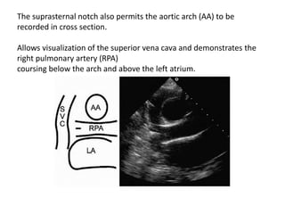 The suprasternal notch also permits the aortic arch (AA) to be
recorded in cross section.
Allows visualization of the superior vena cava and demonstrates the
right pulmonary artery (RPA)
coursing below the arch and above the left atrium.
 