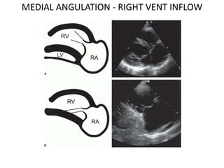 MEDIAL ANGULATION - RIGHT VENT INFLOW
 