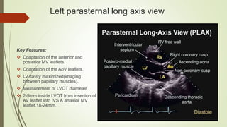Left parasternal long axis view
Key Features:
 Coaptation of the anterior and
posterior MV leaflets.
 Coaptation of the AoV leaflets.
 LV cavity maximized(imaging
between papillary muscles).
 Measurement of LVOT diameter
 2-5mm inside LVOT from insertion of
AV leaflet into IVS & anterior MV
leaflet.18-24mm.
 