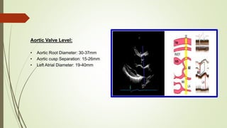 Aortic Valve Level:
• Aortic Root Diameter: 30-37mm
• Aortic cusp Separation: 15-26mm
• Left Atrial Diameter: 19-40mm
 