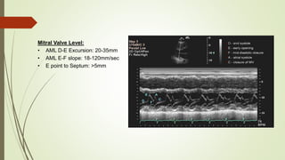 Mitral Valve Level:
• AML D-E Excursion: 20-35mm
• AML E-F slope: 18-120mm/sec
• E point to Septum: >5mm
 