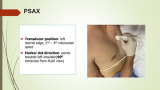 PSAX
 Transducer position: left
sternal edge; 2nd – 4th intercostal
space
 Marker dot direction: points
towards left shoulder(900
clockwise from PLAX view)
 