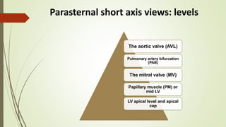 Parasternal short axis views: levels
The aortic valve (AVL)
Pulmonary artery bifurcation
(PAB)
The mitral valve (MV)
Papillary muscle (PM) or
mid LV
LV apical level and apical
cap
 