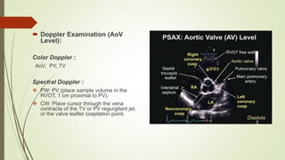  Doppler Examination (AoV
Level):
Color Doppler :
AoV, PV, TV
Spectral Doppler :
 PW: PV (place sample volume in the
RVOT, 1 cm proximal to PV).
 CW: Place cursor through the vena
contracta of the TV or PV regurgitant jet,
or the valve leaflet coaptation point.
 