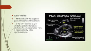  Key Features
 MV leaflets with the coaptation
point at the center of the ventricle
 If the valve appears to open
medially, rotate the transducer
clockwise for a more complete view;
if it opens laterally, rotate
counterclockwise.
 