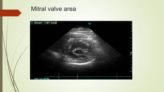 Mitral valve area
 