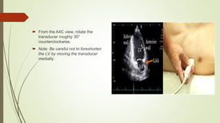  From the A4C view, rotate the
transducer roughly 30°
counterclockwise.
 Note: Be careful not to foreshorten
the LV by moving the transducer
medially.
 