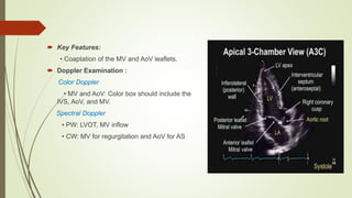  Key Features:
• Coaptation of the MV and AoV leaflets.
 Doppler Examination :
Color Doppler
• MV and AoV: Color box should include the
IVS, AoV, and MV.
Spectral Doppler
• PW: LVOT, MV inflow
• CW: MV for regurgitation and AoV for AS
 