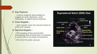  Key Features
• Look for anatomic abnormalities to
suggest an aortic dissection, aortic
coarctation, or patent ductus arteriosis
 Color Doppler :
• Arch vessels: Color box should include all
of the arch vessels.
 Spectral Doppler :
• PW sampling of the proximal DAo
(holodiastolic flow reversal seen in moderate
to severe AR) or any areas of turbulence.
• CW of AoV for aortic valve jet.
 