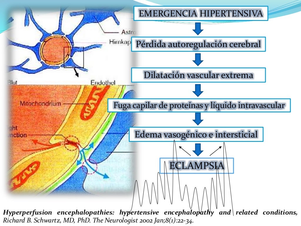 Eclampsia
