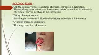 Frothy Stage Eclampsia: An Obstetric Emergency,Critical Maternal Health Condition | PPTX