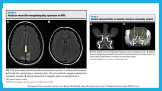Eclampsia in the 21st century, Michal Fishel Bartal, MD; Baha M. Sibai, MD,American Journal of Obstetrics & Gynecology MONTH 2020
 