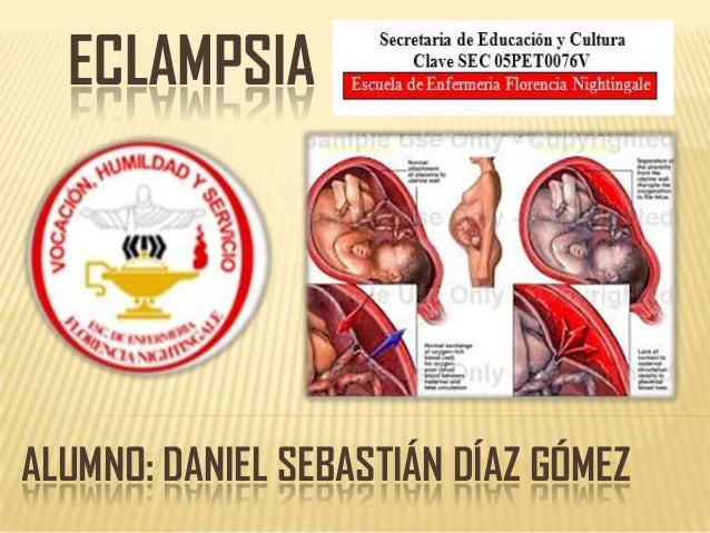 Eclampsia Toxemias Gravidicas En El Embarazo