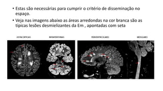 • Estas são necessárias para cumprir o critério de disseminação no
espaço.
• Veja nas imagens abaixo as áreas arredondas na cor branca são as
típicas lesões desmielizantes da Em , apontadas com seta
 