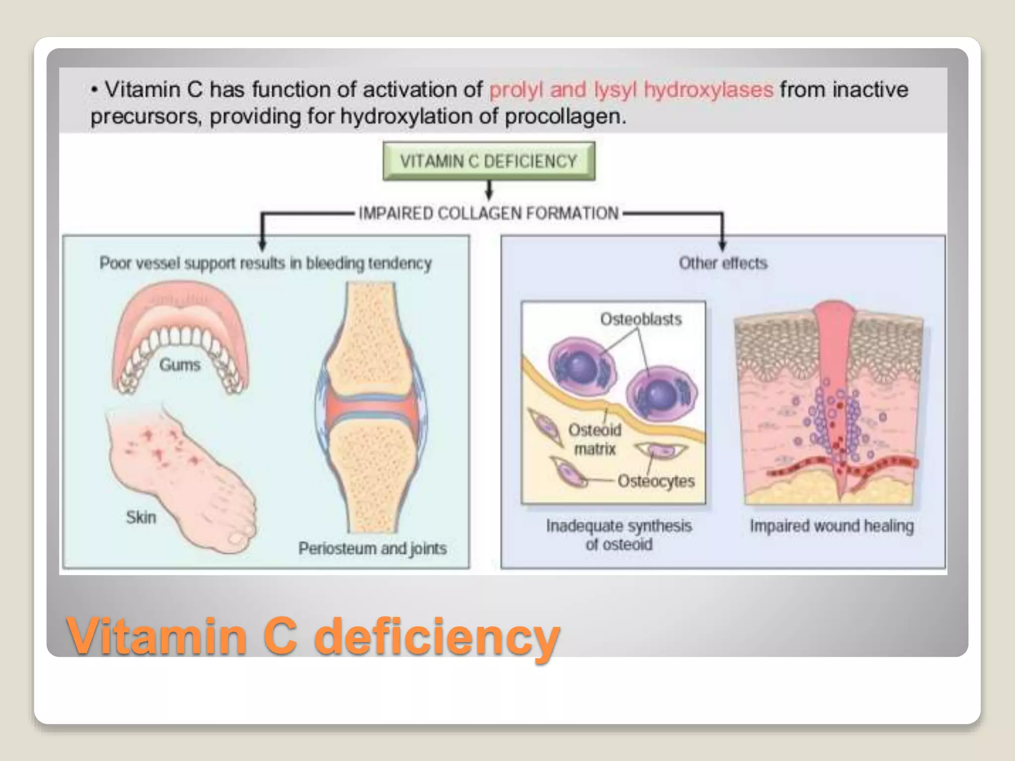 Vitamin C deficiency
 