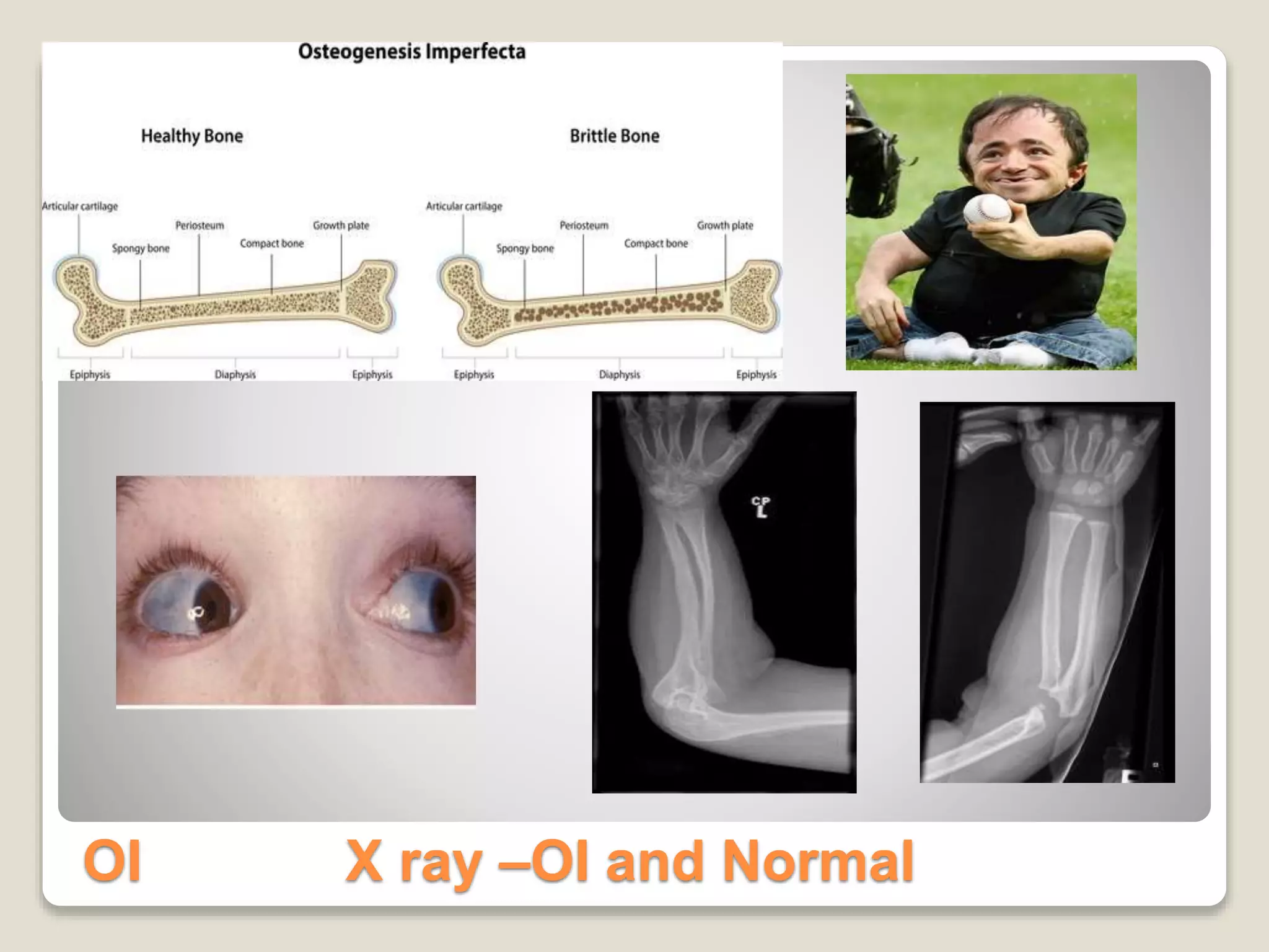 OI X ray –OI and Normal
 