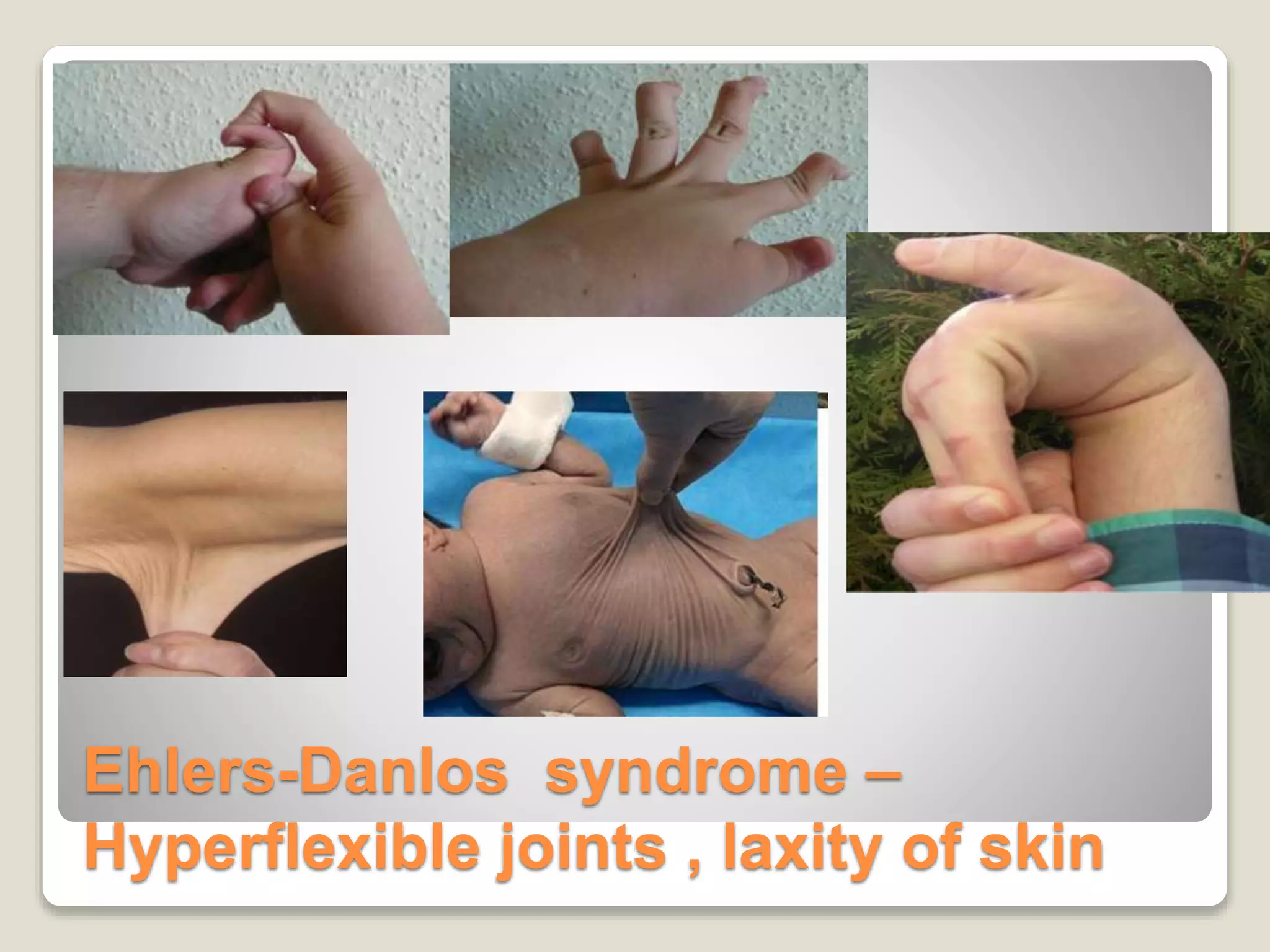 Ehlers-Danlos syndrome –
Hyperflexible joints , laxity of skin
 