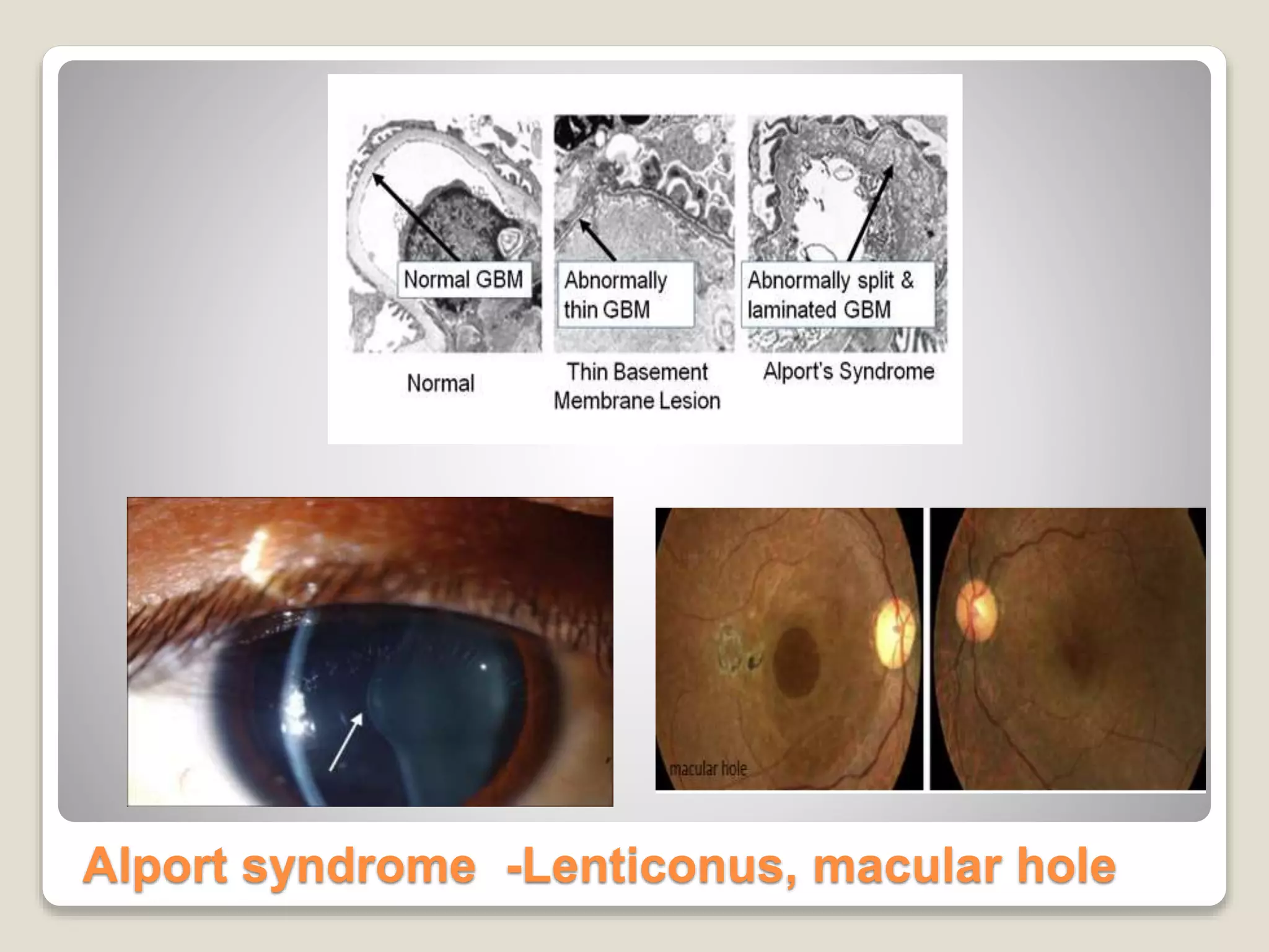 Alport syndrome -Lenticonus, macular hole
 