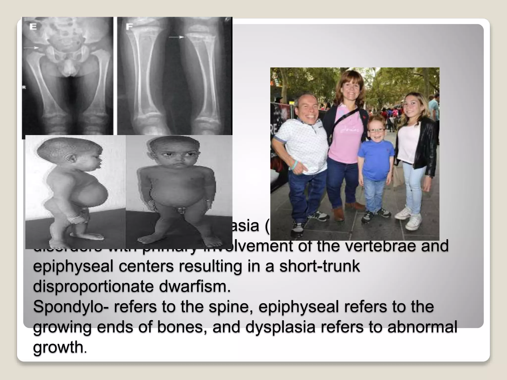 Spondyloepiphyseal dysplasia (SED) is a group of
disorders with primary involvement of the vertebrae and
epiphyseal centers resulting in a short-trunk
disproportionate dwarfism.
Spondylo- refers to the spine, epiphyseal refers to the
growing ends of bones, and dysplasia refers to abnormal
growth.
 