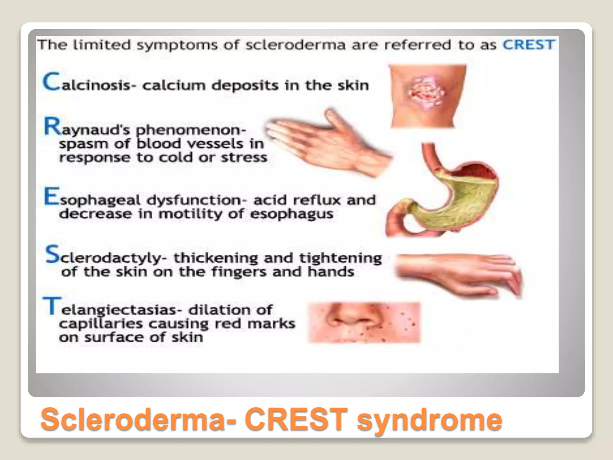 Scleroderma- CREST syndrome
 