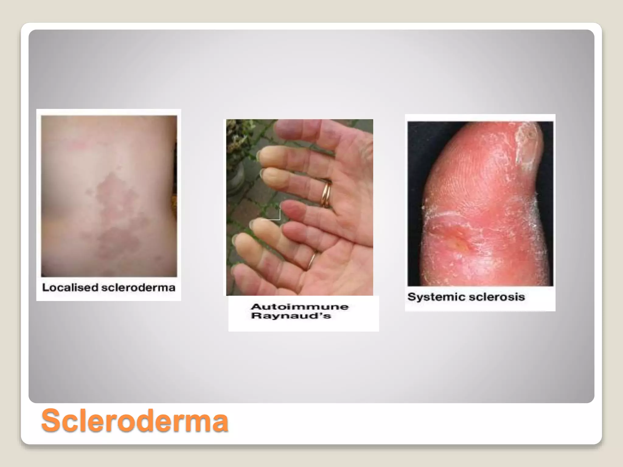 Scleroderma
 