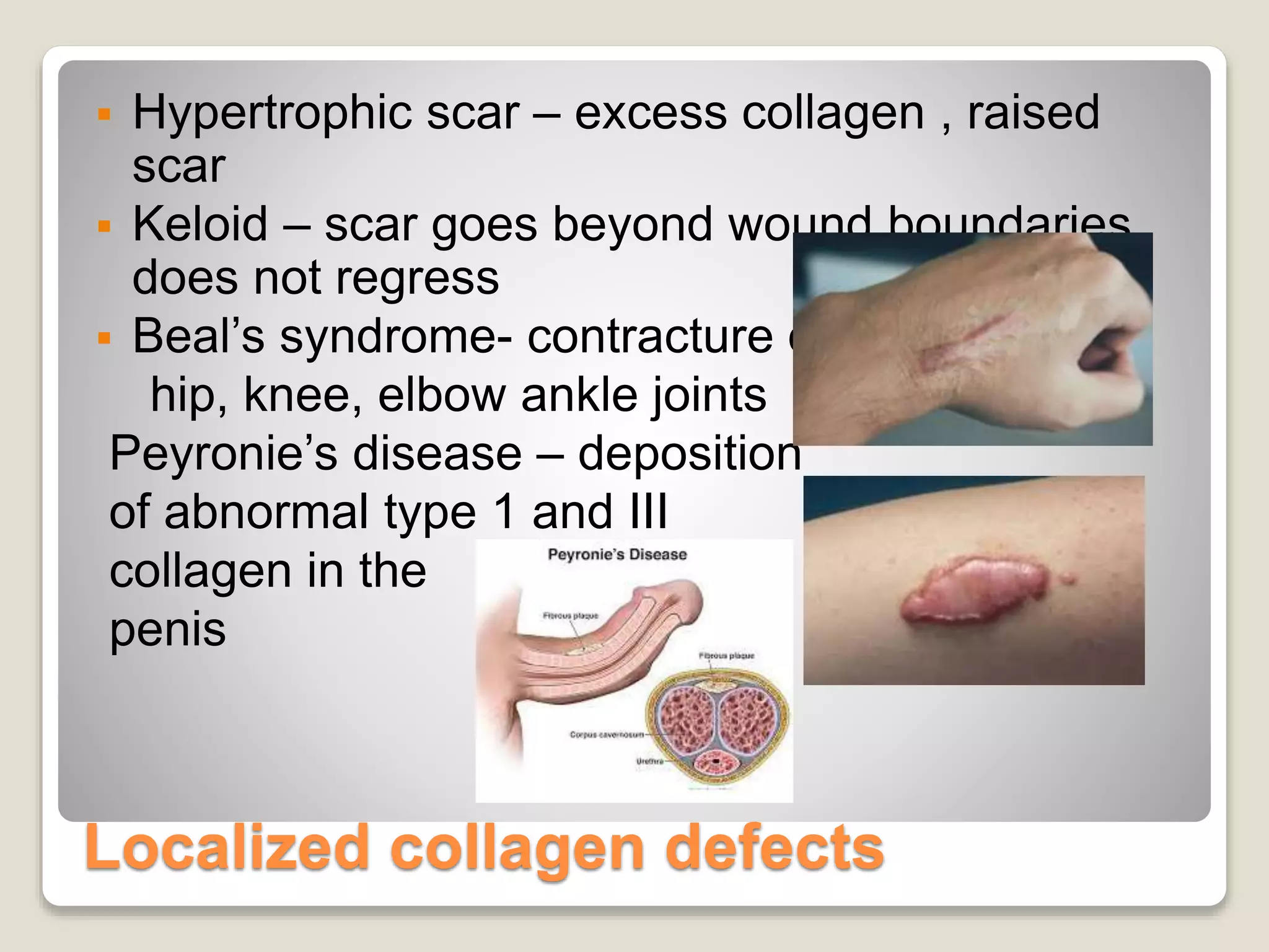 Localized collagen defects
 Hypertrophic scar – excess collagen , raised
scar
 Keloid – scar goes beyond wound boundaries
does not regress
 Beal’s syndrome- contracture of
hip, knee, elbow ankle joints
Peyronie’s disease – deposition
of abnormal type 1 and III
collagen in the
penis
 