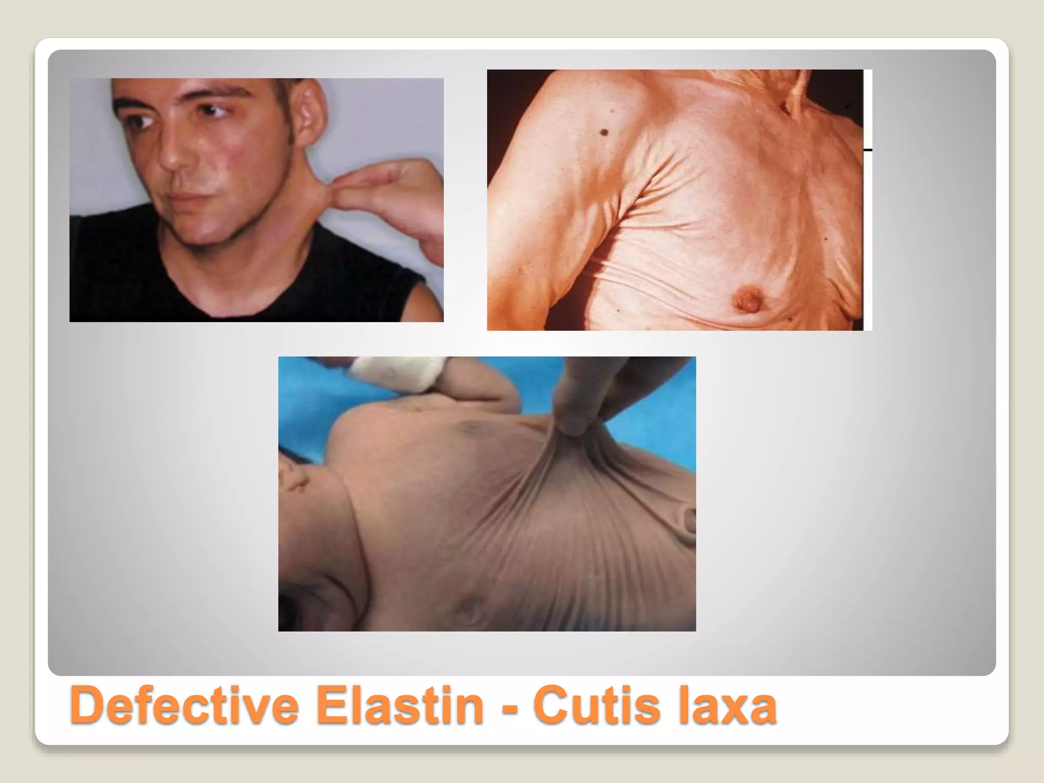 Defective Elastin - Cutis laxa
 