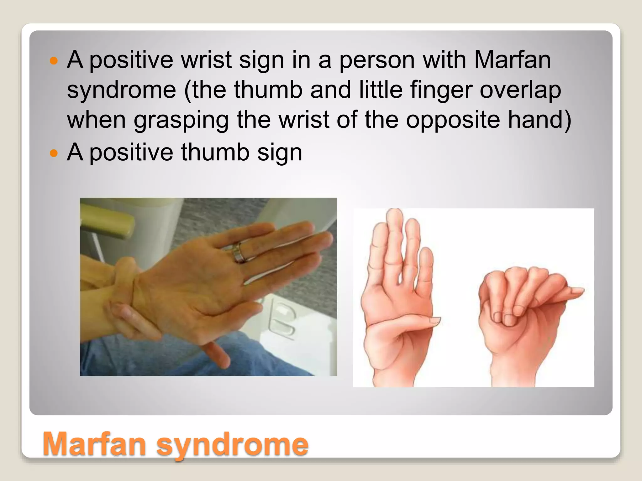 Marfan syndrome
 A positive wrist sign in a person with Marfan
syndrome (the thumb and little finger overlap
when grasping the wrist of the opposite hand)
 A positive thumb sign
 