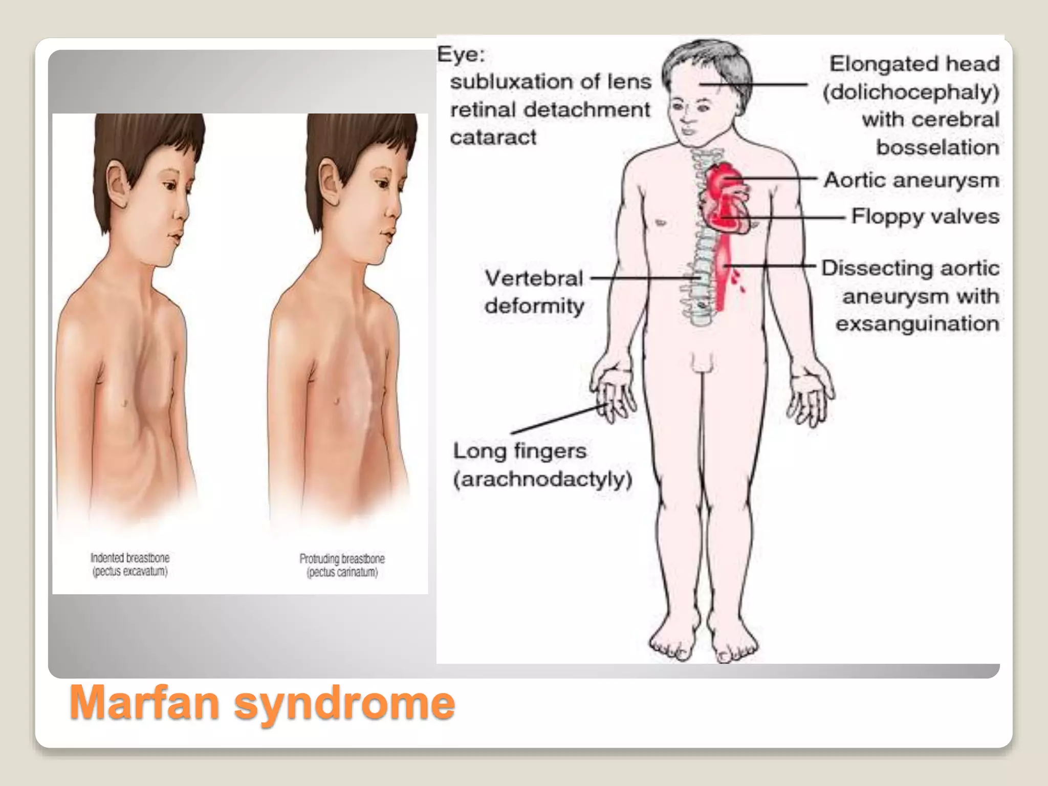 Marfan syndrome
 