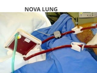 NOVA LUNG
 
