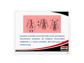 ECMO: Extracorporial Membrane Oxygenation | PDF