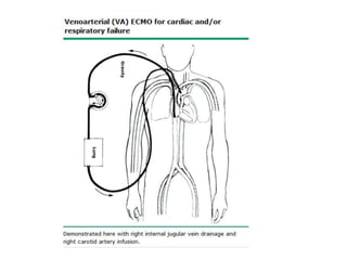 ECMO | PPTX