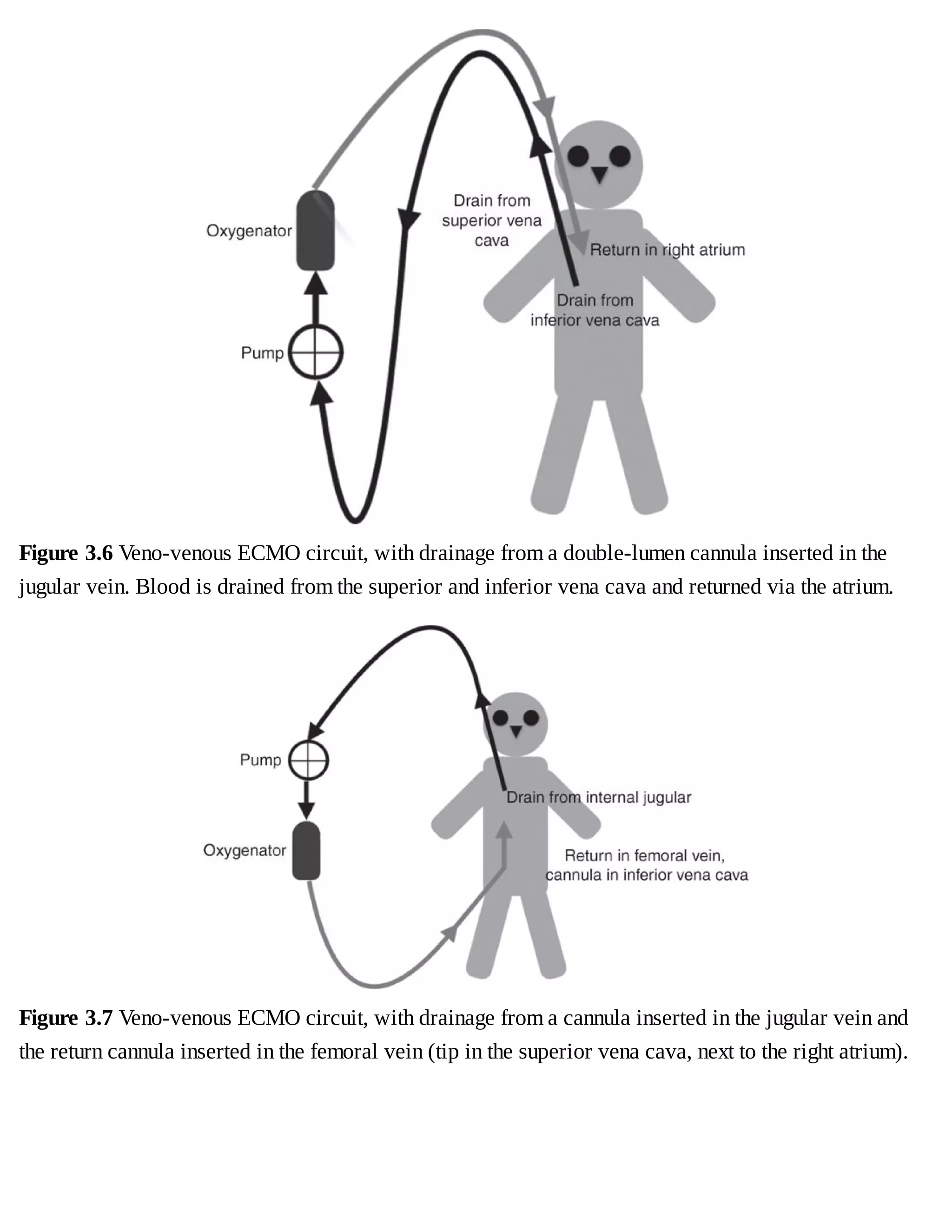 Figure	3.6	Veno-venous	ECMO	circuit,	with	drainage	from	a	double-lumen	cannula	inserted	in	the
jugular	vein.	Blood	is	drained	from	the	superior	and	inferior	vena	cava	and	returned	via	the	atrium.
Figure	3.7	Veno-venous	ECMO	circuit,	with	drainage	from	a	cannula	inserted	in	the	jugular	vein	and
the	return	cannula	inserted	in	the	femoral	vein	(tip	in	the	superior	vena	cava,	next	to	the	right	atrium).
 