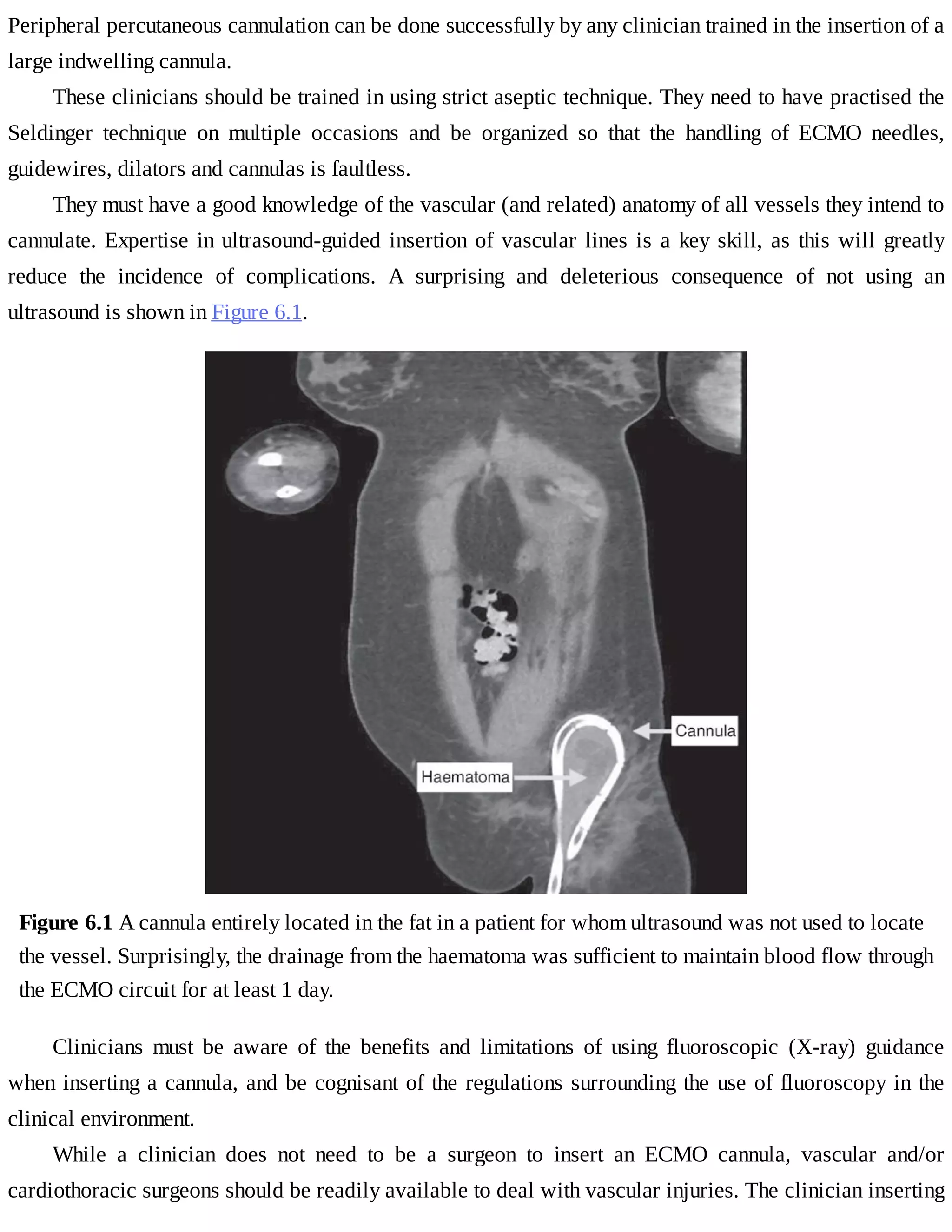 Peripheral	percutaneous	cannulation	can	be	done	successfully	by	any	clinician	trained	in	the	insertion	of	a
large	indwelling	cannula.
These	clinicians	should	be	trained	in	using	strict	aseptic	technique.	They	need	to	have	practised	the
Seldinger	 technique	 on	 multiple	 occasions	 and	 be	 organized	 so	 that	 the	 handling	 of	 ECMO	 needles,
guidewires,	dilators	and	cannulas	is	faultless.
They	must	have	a	good	knowledge	of	the	vascular	(and	related)	anatomy	of	all	vessels	they	intend	to
cannulate.	Expertise	in	ultrasound-guided	insertion	of	vascular	lines	is	a	key	skill,	as	this	will	greatly
reduce	 the	 incidence	 of	 complications.	 A	 surprising	 and	 deleterious	 consequence	 of	 not	 using	 an
ultrasound	is	shown	in	Figure	6.1.
Figure	6.1	A	cannula	entirely	located	in	the	fat	in	a	patient	for	whom	ultrasound	was	not	used	to	locate
the	vessel.	Surprisingly,	the	drainage	from	the	haematoma	was	sufficient	to	maintain	blood	flow	through
the	ECMO	circuit	for	at	least	1	day.
Clinicians	 must	 be	 aware	 of	 the	 benefits	 and	 limitations	 of	 using	 fluoroscopic	 (X-ray)	 guidance
when	inserting	a	cannula,	and	be	cognisant	of	the	regulations	surrounding	the	use	of	fluoroscopy	in	the
clinical	environment.
While	 a	 clinician	 does	 not	 need	 to	 be	 a	 surgeon	 to	 insert	 an	 ECMO	 cannula,	 vascular	 and/or
cardiothoracic	surgeons	should	be	readily	available	to	deal	with	vascular	injuries.	The	clinician	inserting
 