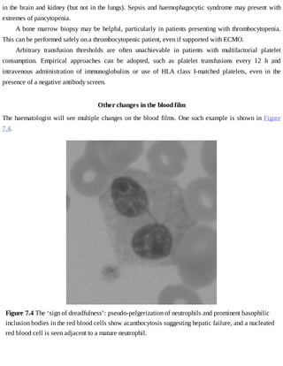 in	the	brain	and	kidney	(but	not	in	the	lungs).	Sepsis	and	haemophagocytic	syndrome	may	present	with
extremes	of	pancytopenia.
A	bone	marrow	biopsy	may	be	helpful,	particularly	in	patients	presenting	with	thrombocytopenia.
This	can	be	performed	safely	on	a	thrombocytopenic	patient,	even	if	supported	with	ECMO.
Arbitrary	 transfusion	 thresholds	 are	 often	 unachievable	 in	 patients	 with	 multifactorial	 platelet
consumption.	 Empirical	 approaches	 can	 be	 adopted,	 such	 as	 platelet	 transfusions	 every	 12	 h	 and
intravenous	 administration	 of	 immunoglobulins	 or	 use	 of	 HLA	 class	 I-matched	 platelets,	 even	 in	 the
presence	of	a	negative	antibody	screen.
Other	changes	in	the	blood	film
The	haematologist	will	see	multiple	changes	on	the	blood	films.	One	such	example	is	shown	in	Figure
7.4.
Figure	7.4	The	‘sign	of	dreadfulness’:	pseudo-pelgerization	of	neutrophils	and	prominent	basophilic
inclusion	bodies	in	the	red	blood	cells	show	acanthocytosis	suggesting	hepatic	failure,	and	a	nucleated
red	blood	cell	is	seen	adjacent	to	a	mature	neutrophil.
 