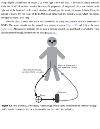 bring	a	higher	concentration	of	oxygen	(O2)	to	the	right	side	of	the	heart.	If	the	cardiac	output	increases
while	the	ECMO	blood	flow	remains	the	same,	the	proportion	of	oxygenated	blood	that	arrives	in	the
right	side	of	the	heart	will	be	decreased.	Analysis	of	blood	gases	in	an	arterial	sample	(obtained	from	the
patient)	will	give	the	end	result	of	the	ECMO	blood	mixed	with	the	patient’s	blood,	which	has	passed
through	the	patient’s	own	lungs.
When	the	blood	is	taken	from	a	vein	and	returned	via	an	artery,	the	system	is	known	as	veno-arterial
ECMO.	 The	 return	 cannula	 can	 be	 inserted	 in	 a	 peripheral	 artery	 (Figures	 3.2	 and	 3.3)	 or	 the	 aorta
(Figure	3.4).	Alternatively,	drainage	can	be	from	a	cannula	inserted	in	a	peripheral	vein	with	the	return
cannula	inserted	through	the	chest	into	the	aorta	(Figure	3.5).
Figure	3.2	Veno-arterial	ECMO	circuit,	with	drainage	from	a	cannula	inserted	in	the	femoral	vein	(tip
in	the	inferior	vena	cava)	and	the	return	cannula	inserted	in	the	femoral	artery.
 