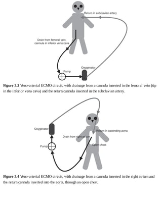 Figure	3.3	Veno-arterial	ECMO	circuit,	with	drainage	from	a	cannula	inserted	in	the	femoral	vein	(tip
in	the	inferior	vena	cava)	and	the	return	cannula	inserted	in	the	subclavian	artery.
Figure	3.4	Veno-arterial	ECMO	circuit,	with	drainage	from	a	cannula	inserted	in	the	right	atrium	and
the	return	cannula	inserted	into	the	aorta,	through	an	open	chest.
 