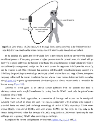 Figure	3.5	Veno-arterial	ECMO	circuit,	with	drainage	from	a	cannula	inserted	in	the	femoral	vein	(tip
in	the	inferior	vena	cava)	and	the	return	cannula	inserted	into	the	aorta,	through	an	open	chest.
In	the	absence	of	a	pump,	the	blood	would	flow	in	the	opposite	direction,	driven	by	the	patient’s
own	blood	pressure.	If	the	pump	generates	a	higher	pressure	than	the	patient’s	own,	the	blood	will	go
from	vein	to	artery	and	bypass	the	function	of	the	heart.	This	would	introduce	a	shunt	with	the	injection	of
venous	blood	(non-oxygenated)	straight	into	the	arterial	system.	An	oxygenator	is	indispensable	to	add	O2
into	the	returned	blood.	This	system	can	then	support	a	failed	heart	(by	providing	the	pump	support)	or	a
failed	lung	(by	providing	the	required	gas	exchange),	or	both	a	failed	heart	and	lungs.	Of	note,	the	system
can	pump	in	line	with	the	normal	circulation	(such	as	when	a	return	cannula	is	inserted	in	the	ascending
aorta;	Figure	3.4)	or	pump	against	the	normal	circulation	(such	as	when	a	return	cannula	is	inserted	in	the
femoral	artery;	Figure	3.2).
Analysis	 of	 blood	 gases	 in	 an	 arterial	 sample	 (obtained	 from	 the	 patient)	 may	 lead	 to
misinterpretation,	as	the	sampled	blood	could	be	coming	from	the	ECMO	circuit	only,	the	patient’s	own
circulation	only,	or	both.
From	 these	 two	 basic	 approaches,	 a	 combination	 of	 drainage	 and	 access	 can	 be	 configured,
including	 return	 in	 both	 an	 artery	 and	 vein.	 The	 chosen	 configuration	 will	 determine	 what	 support	 is
provided,	 hence	 the	 mixed	 (and	 confusing)	 terminology	 of	 cardiac	 ECMO,	 respiratory	 ECMO,	 veno-
venous	 ECMO,	 veno-arterial	 ECMO,	 veno-veno-arterial	 ECMO,	 etc.	 We	 prefer	 to	 refer	 only	 to	 the
support	being	provided,	rather	than	the	type	of	ECMO,	using	cardiac	ECMO	when	supporting	the	heart
and	lungs,	and	respiratory	ECMO	when	supporting	gas	exchange.
Examples	of	the	various	configurations	are	shown	in	Figures	3.6,	3.7,	3.8	and	3.9.
 