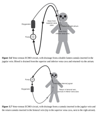 Figure	3.6	Veno-venous	ECMO	circuit,	with	drainage	from	a	double-lumen	cannula	inserted	in	the
jugular	vein.	Blood	is	drained	from	the	superior	and	inferior	vena	cava	and	returned	via	the	atrium.
Figure	3.7	Veno-venous	ECMO	circuit,	with	drainage	from	a	cannula	inserted	in	the	jugular	vein	and
the	return	cannula	inserted	in	the	femoral	vein	(tip	in	the	superior	vena	cava,	next	to	the	right	atrium).
 