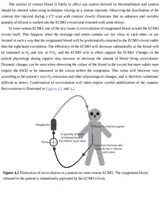 The	suction	of	venous	blood	is	likely	to	affect	any	system	derived	on	thermodilution	and	caution
should	be	exerted	when	using	techniques	relying	on	a	venous	injectate.	Observing	the	distribution	of	the
contrast	 dye	 injected	 during	 a	 CT	 scan	 with	 contrast	 clearly	 illustrates	 that	 an	 unknown	 and	 variable
quantity	of	diluent	is	sucked	into	the	ECMO	circuit	(and	returned	with	some	delay).
In	veno-venous	ECMO,	one	of	the	key	issues	is	recirculation	of	oxygenated	blood	around	the	ECMO
circuit	 itself.	 This	 happens	 when	 the	 drainage	 and	 return	 cannula	 are	 too	 close	 to	 each	 other,	 or	 are
located	in	such	a	way	that	the	oxygenated	blood	will	be	preferentially	returned	to	the	ECMO	circuit	rather
than	the	right	heart	circulation.	The	efficiency	of	the	ECMO	will	decrease	substantially	as	the	blood	will
be	saturated	in	O2	 and	 low	 in	 CO2,	 and	 the	 ECMO	 will	 in	 effect	 support	 the	 ECMO.	 Changes	 in	 the
patient	 physiology	 during	 support	 may	 increase	 or	 decrease	 the	 amount	 of	 blood	 being	 recirculated.
Dramatic	changes	can	be	seen	when	observing	the	colour	of	the	blood	in	the	circuit	but	more	subtle	ones
require	 the	 PaO2	 to	 be	 measured	 in	 the	 circuit	 before	 the	 oxygenator.	 This	 value	 will	 however	 vary
according	to	the	patient’s	own	O2	extraction	and	other	physiological	changes,	and	is	therefore	sometimes
difficult	to	detect.	Confirmation	of	recirculation	will	often	require	careful	mobilization	of	the	cannula.
Recirculation	is	illustrated	in	Figures	4.1	and	4.2.
Figure	4.1	Illustration	of	recirculation	in	a	patient	on	veno-venous	ECMO.	The	oxygenated	blood
returned	to	the	patient	is	immediately	aspirated	by	the	ECMO	circuit.
 