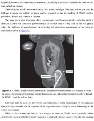 Peripheral	percutaneous	cannulation	can	be	done	successfully	by	any	clinician	trained	in	the	insertion	of	a
large	indwelling	cannula.
These	clinicians	should	be	trained	in	using	strict	aseptic	technique.	They	need	to	have	practised	the
Seldinger	 technique	 on	 multiple	 occasions	 and	 be	 organized	 so	 that	 the	 handling	 of	 ECMO	 needles,
guidewires,	dilators	and	cannulas	is	faultless.
They	must	have	a	good	knowledge	of	the	vascular	(and	related)	anatomy	of	all	vessels	they	intend	to
cannulate.	Expertise	in	ultrasound-guided	insertion	of	vascular	lines	is	a	key	skill,	as	this	will	greatly
reduce	 the	 incidence	 of	 complications.	 A	 surprising	 and	 deleterious	 consequence	 of	 not	 using	 an
ultrasound	is	shown	in	Figure	6.1.
Figure	6.1	A	cannula	entirely	located	in	the	fat	in	a	patient	for	whom	ultrasound	was	not	used	to	locate
the	vessel.	Surprisingly,	the	drainage	from	the	haematoma	was	sufficient	to	maintain	blood	flow	through
the	ECMO	circuit	for	at	least	1	day.
Clinicians	 must	 be	 aware	 of	 the	 benefits	 and	 limitations	 of	 using	 fluoroscopic	 (X-ray)	 guidance
when	inserting	a	cannula,	and	be	cognisant	of	the	regulations	surrounding	the	use	of	fluoroscopy	in	the
clinical	environment.
While	 a	 clinician	 does	 not	 need	 to	 be	 a	 surgeon	 to	 insert	 an	 ECMO	 cannula,	 vascular	 and/or
cardiothoracic	surgeons	should	be	readily	available	to	deal	with	vascular	injuries.	The	clinician	inserting
 