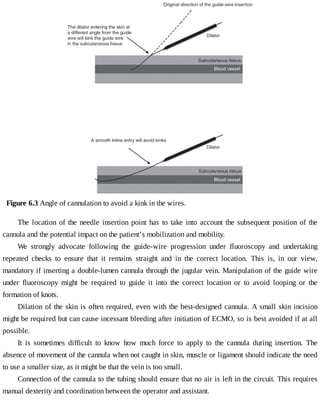 Figure	6.3	Angle	of	cannulation	to	avoid	a	kink	in	the	wires.
The	location	of	the	needle	insertion	point	has	to	take	into	account	the	subsequent	position	of	the
cannula	and	the	potential	impact	on	the	patient’s	mobilization	and	mobility.
We	 strongly	 advocate	 following	 the	 guide-wire	 progression	 under	 fluoroscopy	 and	 undertaking
repeated	 checks	 to	 ensure	 that	 it	 remains	 straight	 and	 in	 the	 correct	 location.	 This	 is,	 in	 our	 view,
mandatory	if	inserting	a	double-lumen	cannula	through	the	jugular	vein.	Manipulation	of	the	guide	wire
under	 fluoroscopy	 might	 be	 required	 to	 guide	 it	 into	 the	 correct	 location	 or	 to	 avoid	 looping	 or	 the
formation	of	knots.
Dilation	of	the	skin	is	often	required,	even	with	the	best-designed	cannula.	A	small	skin	incision
might	be	required	but	can	cause	incessant	bleeding	after	initiation	of	ECMO,	so	is	best	avoided	if	at	all
possible.
It	 is	 sometimes	 difficult	 to	 know	 how	 much	 force	 to	 apply	 to	 the	 cannula	 during	 insertion.	 The
absence	of	movement	of	the	cannula	when	not	caught	in	skin,	muscle	or	ligament	should	indicate	the	need
to	use	a	smaller	size,	as	it	might	be	that	the	vein	is	too	small.
Connection	of	the	cannula	to	the	tubing	should	ensure	that	no	air	is	left	in	the	circuit.	This	requires
manual	dexterity	and	coordination	between	the	operator	and	assistant.
 