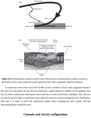 Figure	6.4	(a)	Reperfusion	cannula	inserted	in	the	femoral	artery.	(b)	Reperfusion	cannula	inserted	in
the	femoral	artery,	with	connection	on	the	reperfusion	line	with	a	continuous	infusion	of	heparin.
A	connection	on	the	return	arm	of	the	ECMO	circuit	is	needed	to	divert	some	oxygenated	blood	to
this	extra	line	and	perfuse	the	leg.	We	have	found	that	a	single-lumen	6	Fr	catheter	can	be	adequate.	One
tip	is	to	infuse	continuously	some	heparin	down	that	line	to	avoid	occlusion	by	a	thrombus.	This	side	arm
can	also	be	used	to	infuse	a	vasodilator	such	as	glyceryl	trinitrate	to	ensure	homogenous	flow	distribution.
Note	 that	 it	 is	 easier	 to	 insert	 the	 reperfusion	 cannula	 before	 inserting	 the	 main	 cannula,	 and	 that
ultrasound	guidance	should	be	used.
Cannula	and	circuit	configuration
 