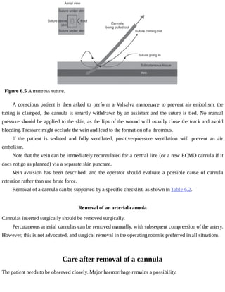 Figure	6.5	A	mattress	suture.
A	conscious	patient	is	then	asked	to	perform	a	Valsalva	manoeuvre	 to	 prevent	 air	 embolism,	 the
tubing	is	clamped,	the	cannula	is	smartly	withdrawn	by	an	assistant	and	the	suture	is	tied.	No	manual
pressure	should	be	applied	to	the	skin,	as	the	lips	of	the	wound	will	usually	close	the	track	and	avoid
bleeding.	Pressure	might	occlude	the	vein	and	lead	to	the	formation	of	a	thrombus.
If	 the	 patient	 is	 sedated	 and	 fully	 ventilated,	 positive-pressure	 ventilation	 will	 prevent	 an	 air
embolism.
Note	that	the	vein	can	be	immediately	recannulated	for	a	central	line	(or	a	new	ECMO	cannula	if	it
does	not	go	as	planned)	via	a	separate	skin	puncture.
Vein	 avulsion	 has	 been	 described,	 and	 the	 operator	 should	 evaluate	 a	 possible	 cause	 of	 cannula
retention	rather	than	use	brute	force.
Removal	of	a	cannula	can	be	supported	by	a	specific	checklist,	as	shown	in	Table	6.2.
Removal	of	an	arterial	cannula
Cannulas	inserted	surgically	should	be	removed	surgically.
Percutaneous	arterial	cannulas	can	be	removed	manually,	with	subsequent	compression	of	the	artery.
However,	this	is	not	advocated,	and	surgical	removal	in	the	operating	room	is	preferred	in	all	situations.
Care	after	removal	of	a	cannula
The	patient	needs	to	be	observed	closely.	Major	haemorrhage	remains	a	possibility.
 